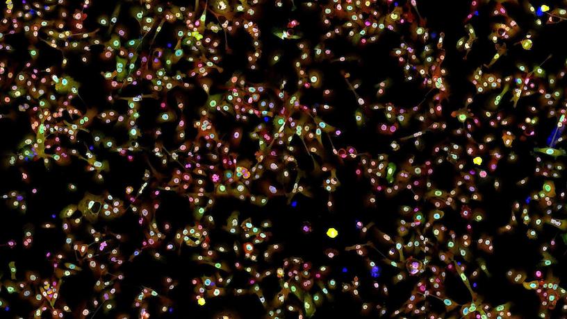 Fluorescence microscopy image of lung cancer cells stained with antibodies against proteins involved in cellular growth.
