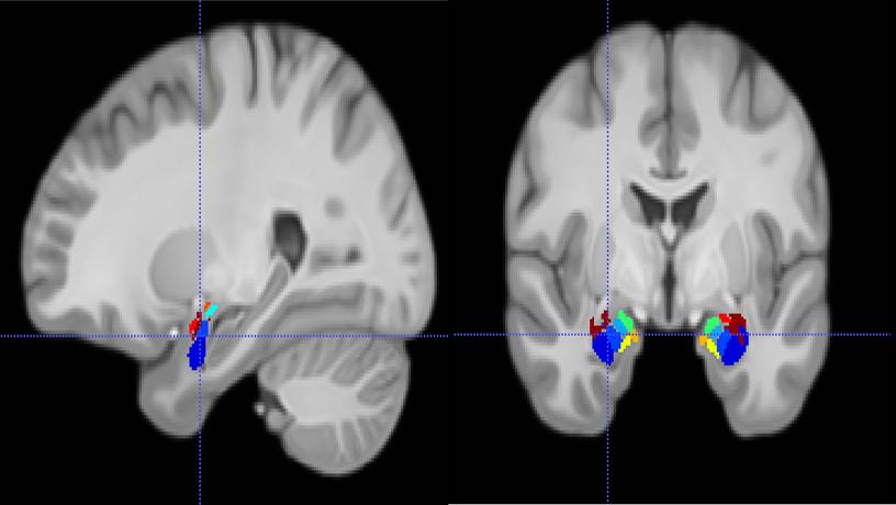 Brain MRI